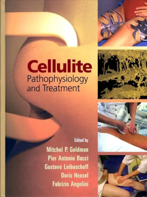 Cellulite: Pathophysiology and Treatment